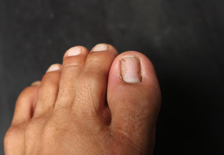 Easily Treat Ingrown Toenails